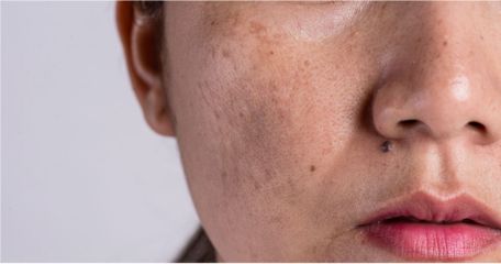 Best Melasma Treatment in Singapore: What Actually Works (Plus Real Cost Breakdown)