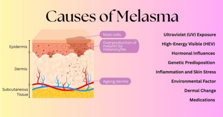 Causes of melasma