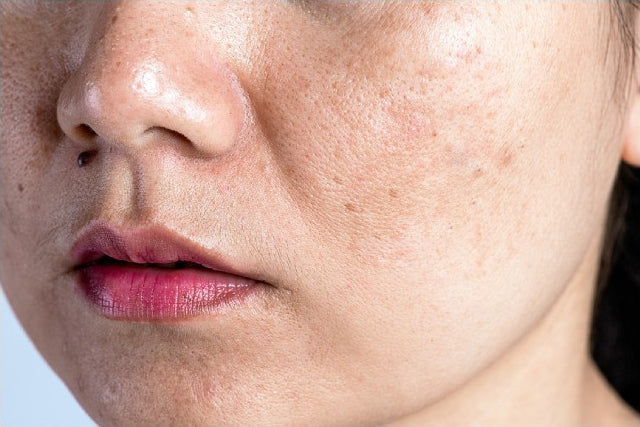 4 Ways To Prevent Pigmentation From Developing On The Face