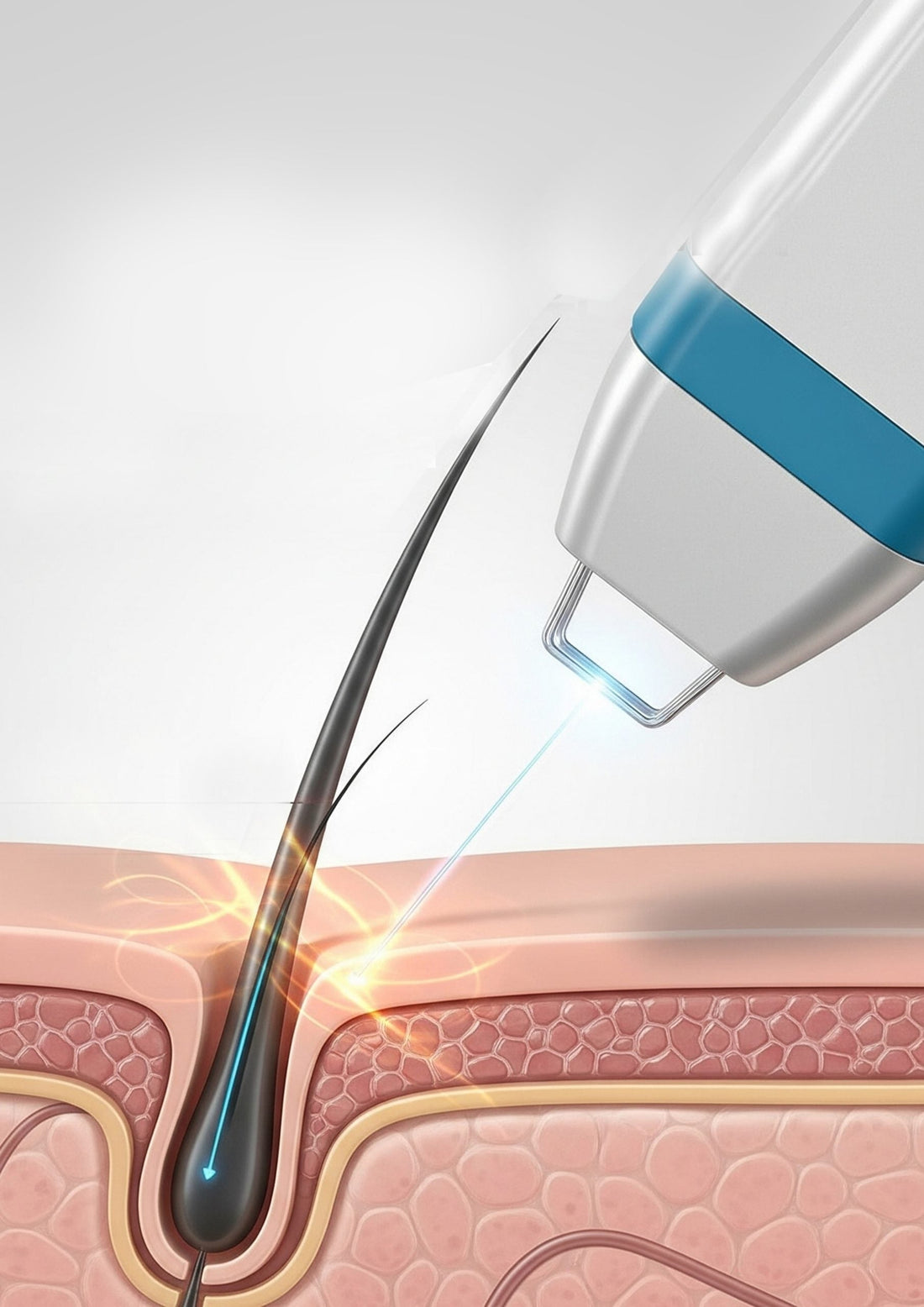 Diode Laser Hair Removal: The Most Effective Solution for Permanent Hair Reduction
