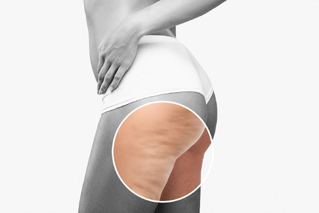 Say Goodbye To Cellulite With These Effective Ways